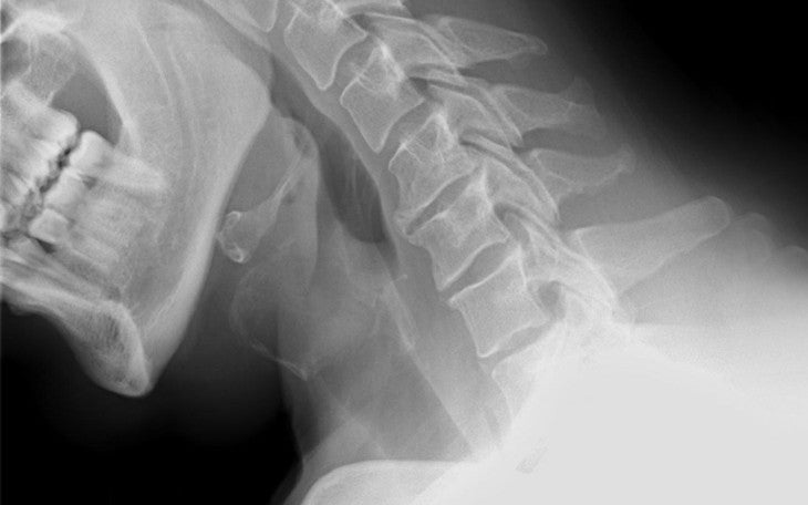 Paleo and Osteoporosis